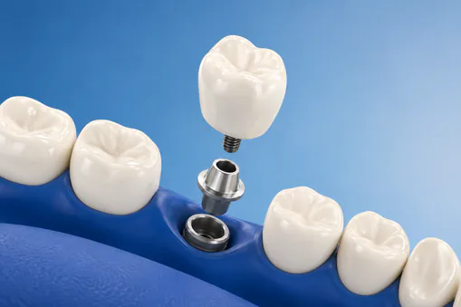 dental implant in mouth illustration