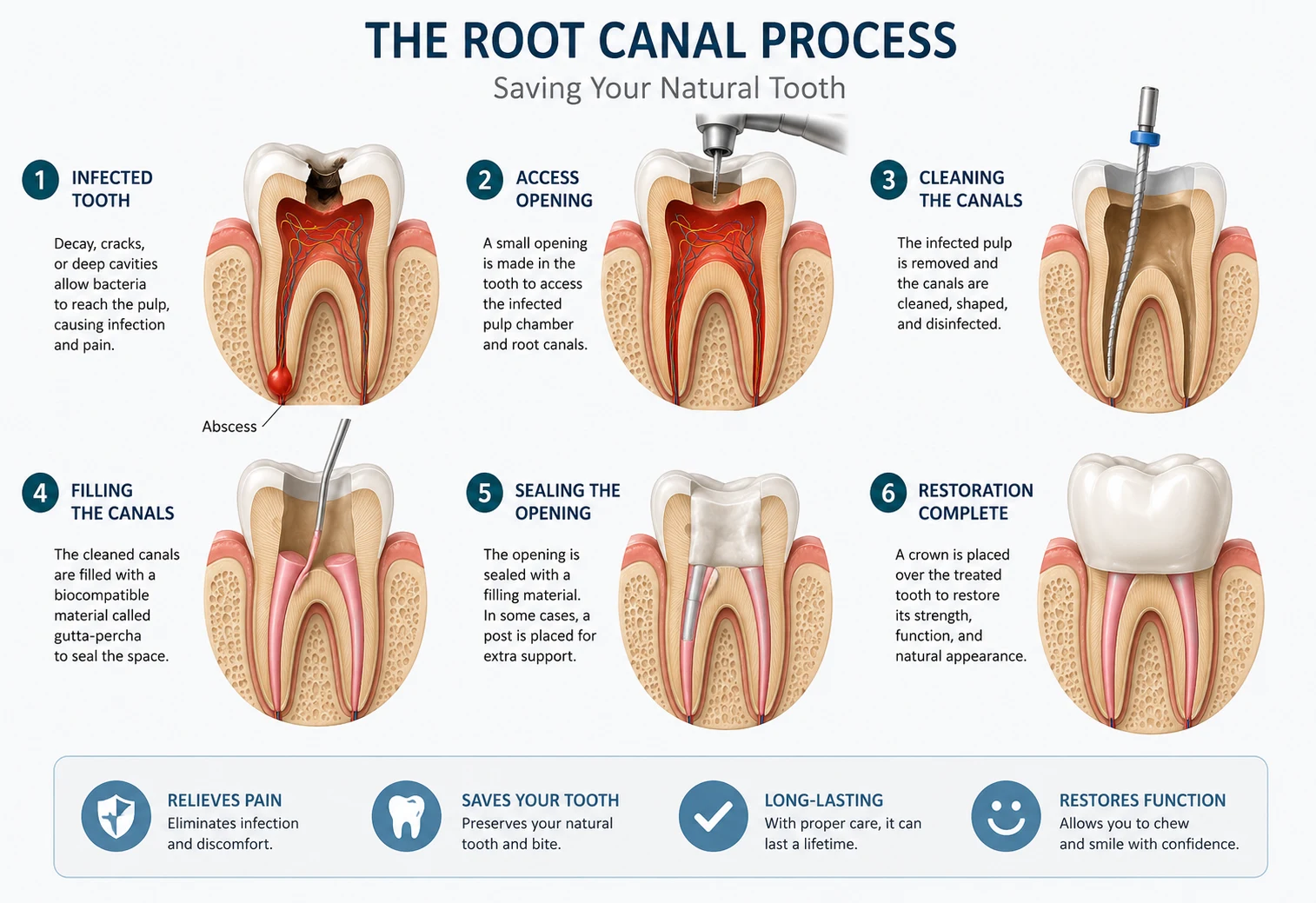 root canal treatment stages